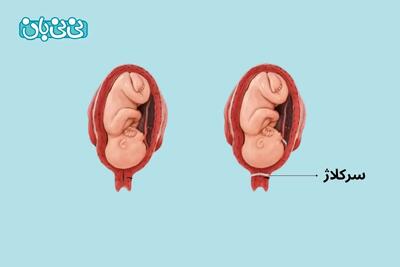  سرکلاژ در بارداری چیست؟۶ مزایا و عوارض دوختن رحم + مراقبت ها