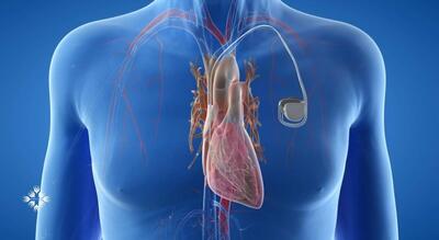  ثبت یک دستاورد نوین در درمان قلب/تعبیه ضربان‌ساز اپی‌کاردیال در زنجان