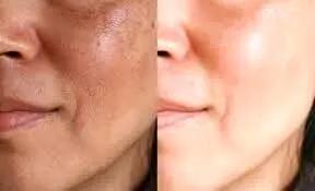  ترانگزامیک اسید چیست؟