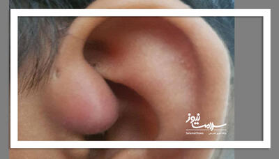  باورهای غلط درباره جرم‌گیری گوش