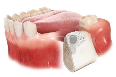  راهنمای جامع بازسازی استخوان فک برای ایمپلنت موفق