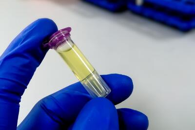  هوش مصنوعی تومور مغزی را از طریق مایع نخاعی ردیابی کرد