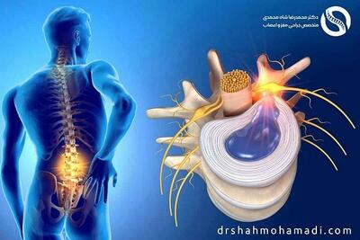  علائم دیسک کمر چیست؟ اصلی ترین نشانه های دیسک کمر از نظر دکتر محمدرضا شاه محمدی